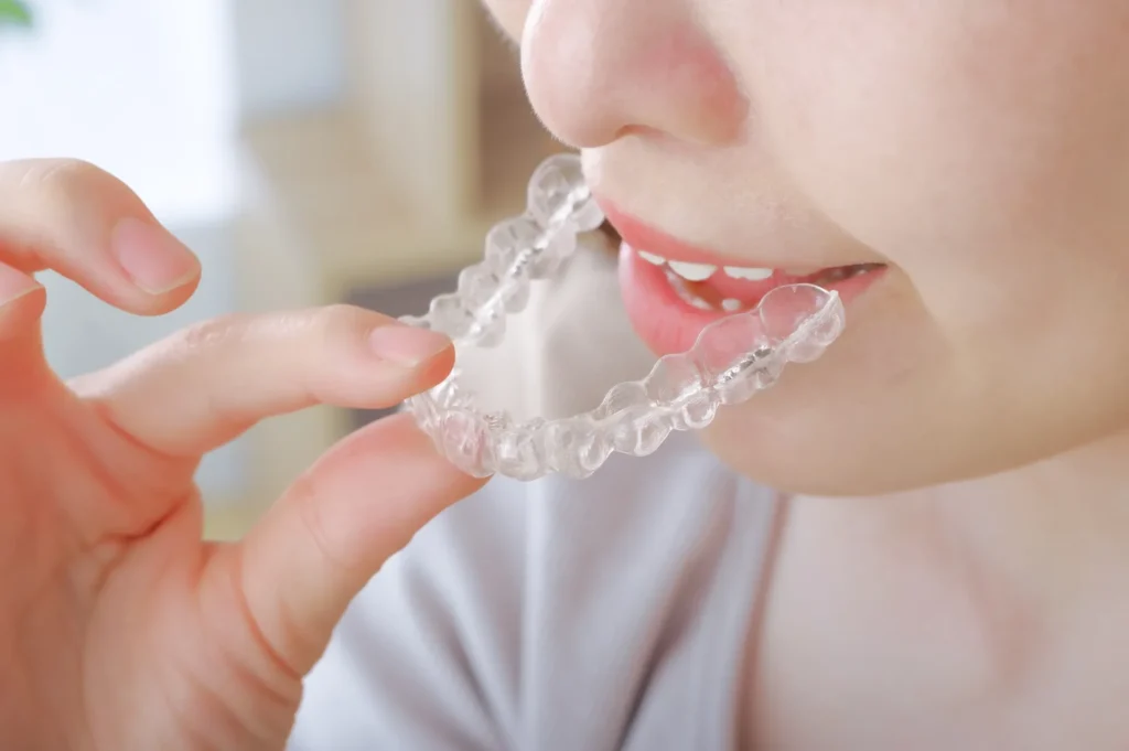 主な矯正治療の種類